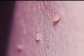 Arm Skin Tag Removal Picture