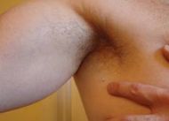 Body Skin Tag Removal Pictures 3