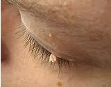 Eye Skin Tag Removal Picture