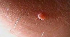 Skin Tag Picture 16