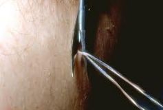 Skin Tag Removal Cleveland