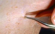Skin Tag Removal Pictures 2