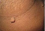 Skin Tag Removal Pictures